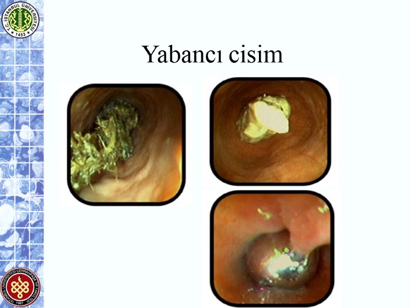 Yabancı cisim